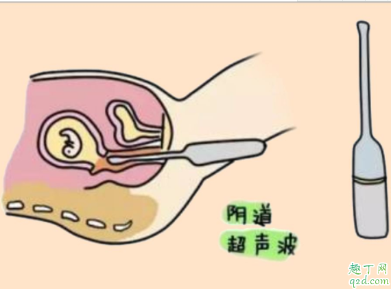 經(jīng)期前可以做陰超嗎 排卵期做陰超會(huì)誤診嗎3