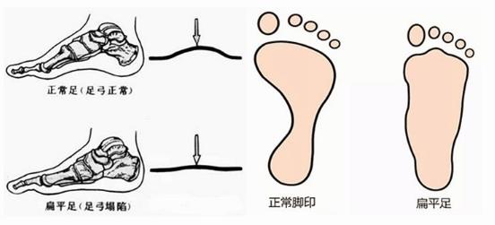 扁平足能跑步嗎？扁平足跑步有什么危害？