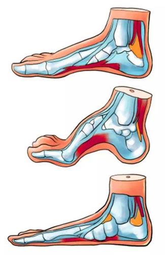 扁平足能跑步嗎？扁平足跑步有什么危害？
